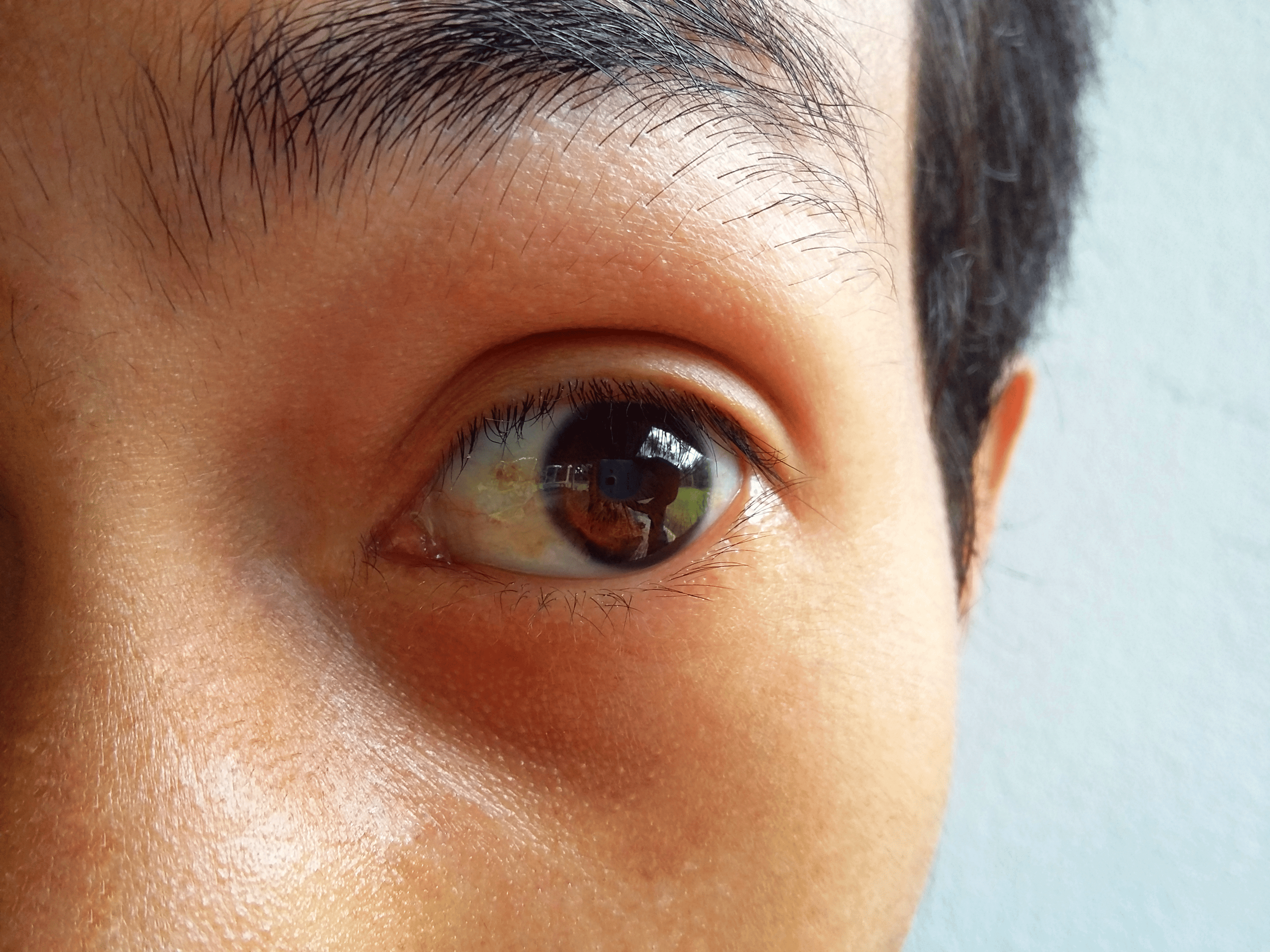 Pinguecula: Yellow bump on eye, Causes & treatment