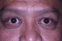 Patient 5 Before - Color Eyes