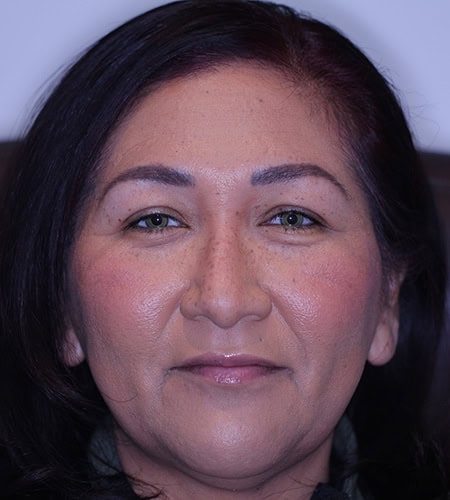 Patient After - Color Eyes