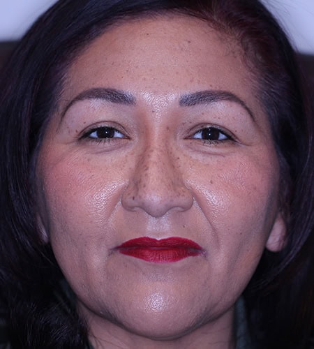 Patient Before - Color Eyes