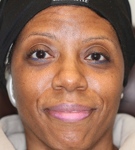 Patient 12 Before - Color Eyes