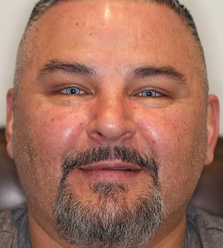 Patient 13 After - Color Eyes